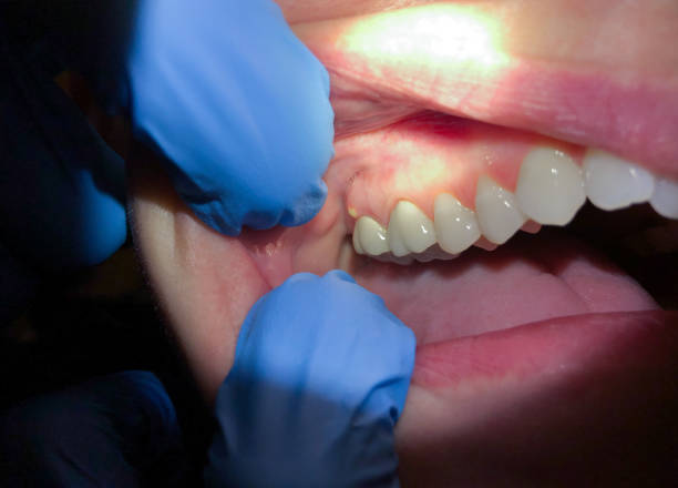 Best Emergency Treatment for Dental Infections or Abscesses in Temple, GA