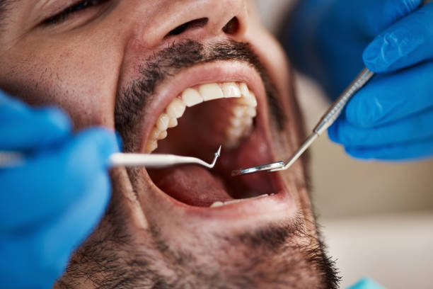 Best Emergency Wisdom Teeth Removal in Temple, GA